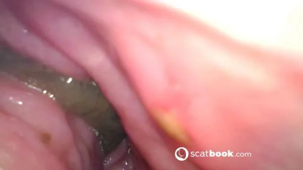 Endoscope In My Ass [FullHD 1080p]  2025 (Actress: Sweet Tinqerbell)